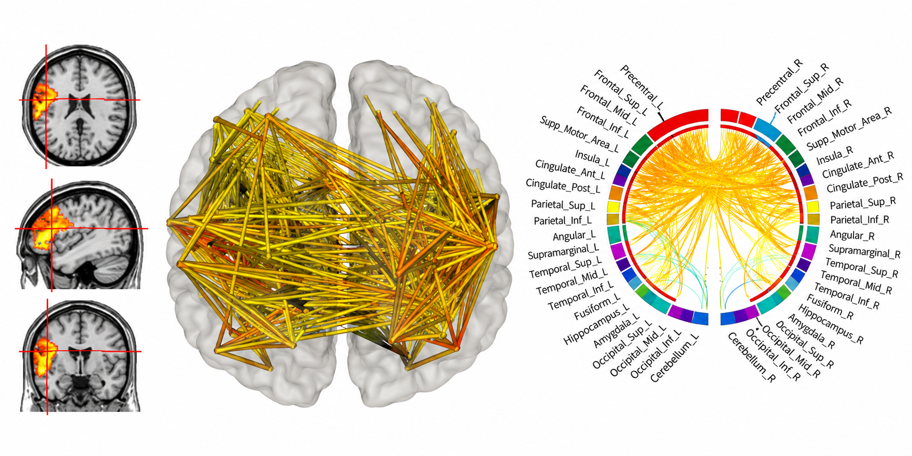 QEEG brain map showing regional activity and connectivity
