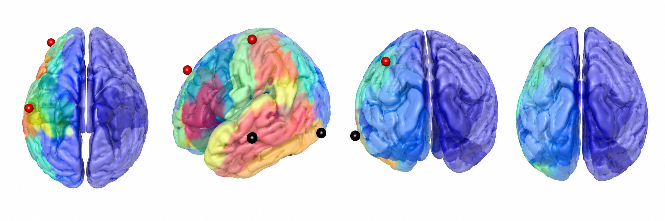 Personalized brain stimulation protocol showing targeted brain regions